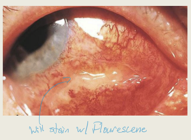 <p>Rolled conjunctival tissue, conjunctival chemosis, and conjunctival hemorrhage. Will stain with fluoresce </p>
