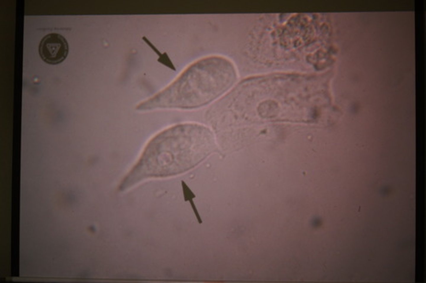 <p>-come from the ureters or the renal pelvis</p><p>- nucleus</p><p>-cytoplasm almost "tadpole" shape</p>