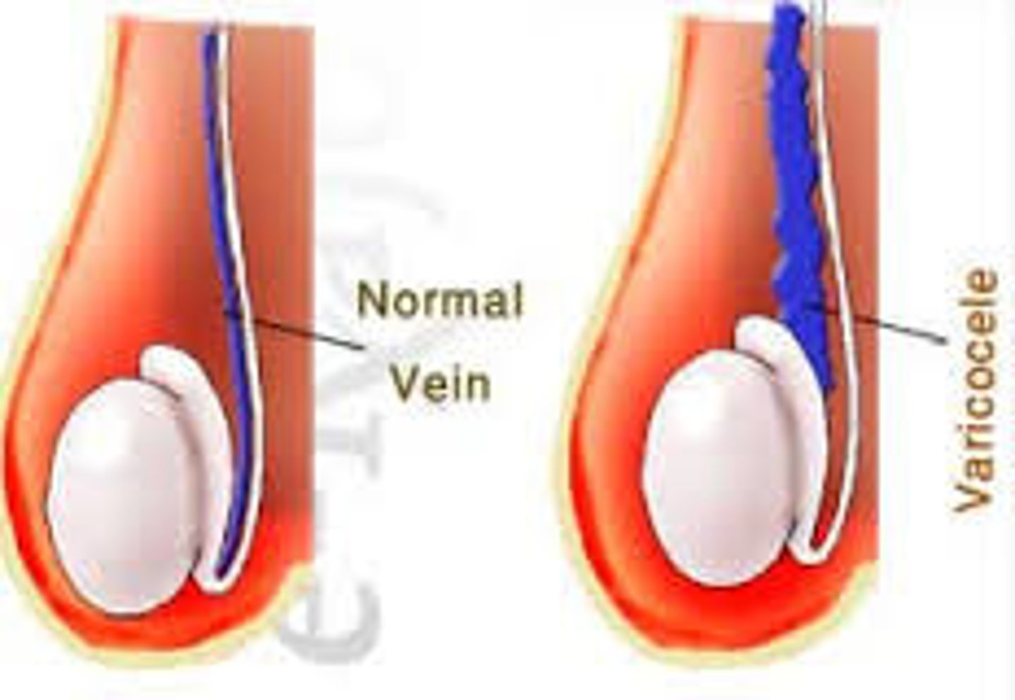 <p>An abnormal enlargement of the pampiniform venous plexus in the scrotum</p>