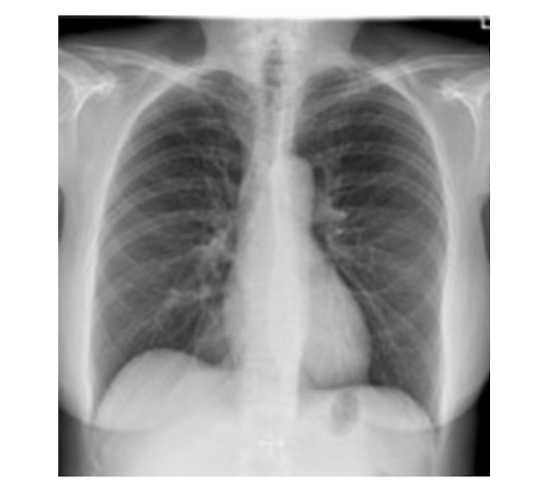 <p>gas (air), fat, soft tissue (water), bone (metal)</p>