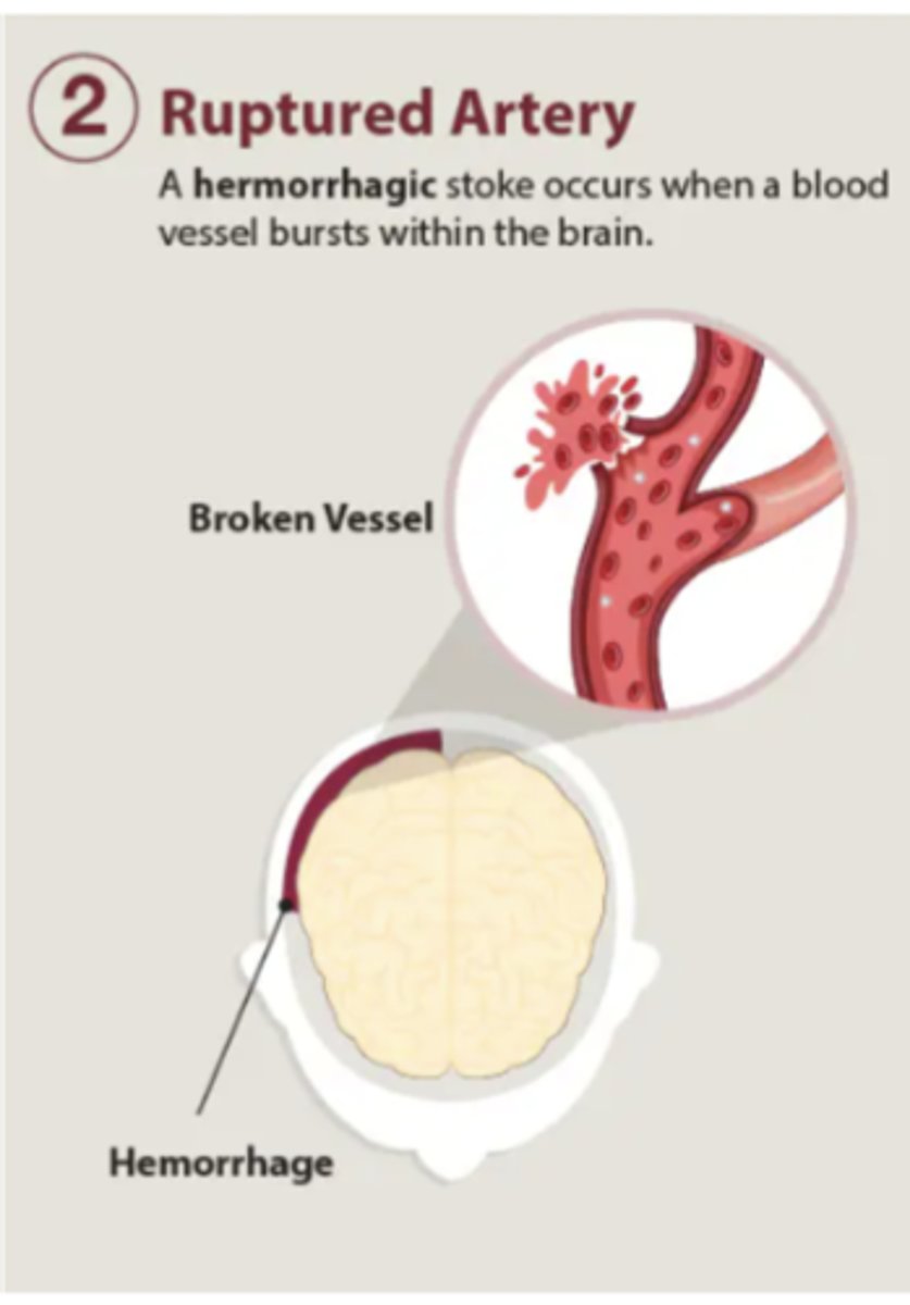 <p>stroke caused by rupture/leak of a weakened blood vessel; aneurysm </p><p>15% of strokes</p>