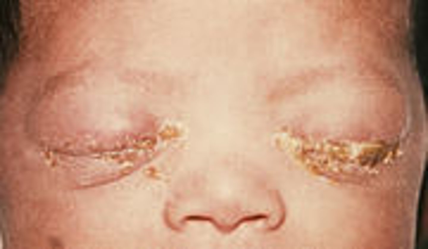 <p>purulent conjunctivitis with profuse exudate and eyelid swelling</p><p>-associated with N. gonorrheae</p>