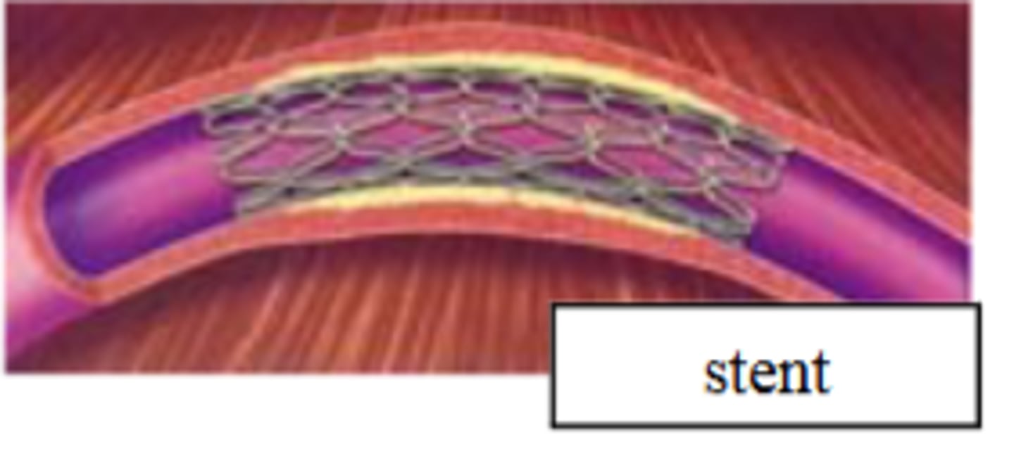 <p>A stent (a mesh tube)</p>