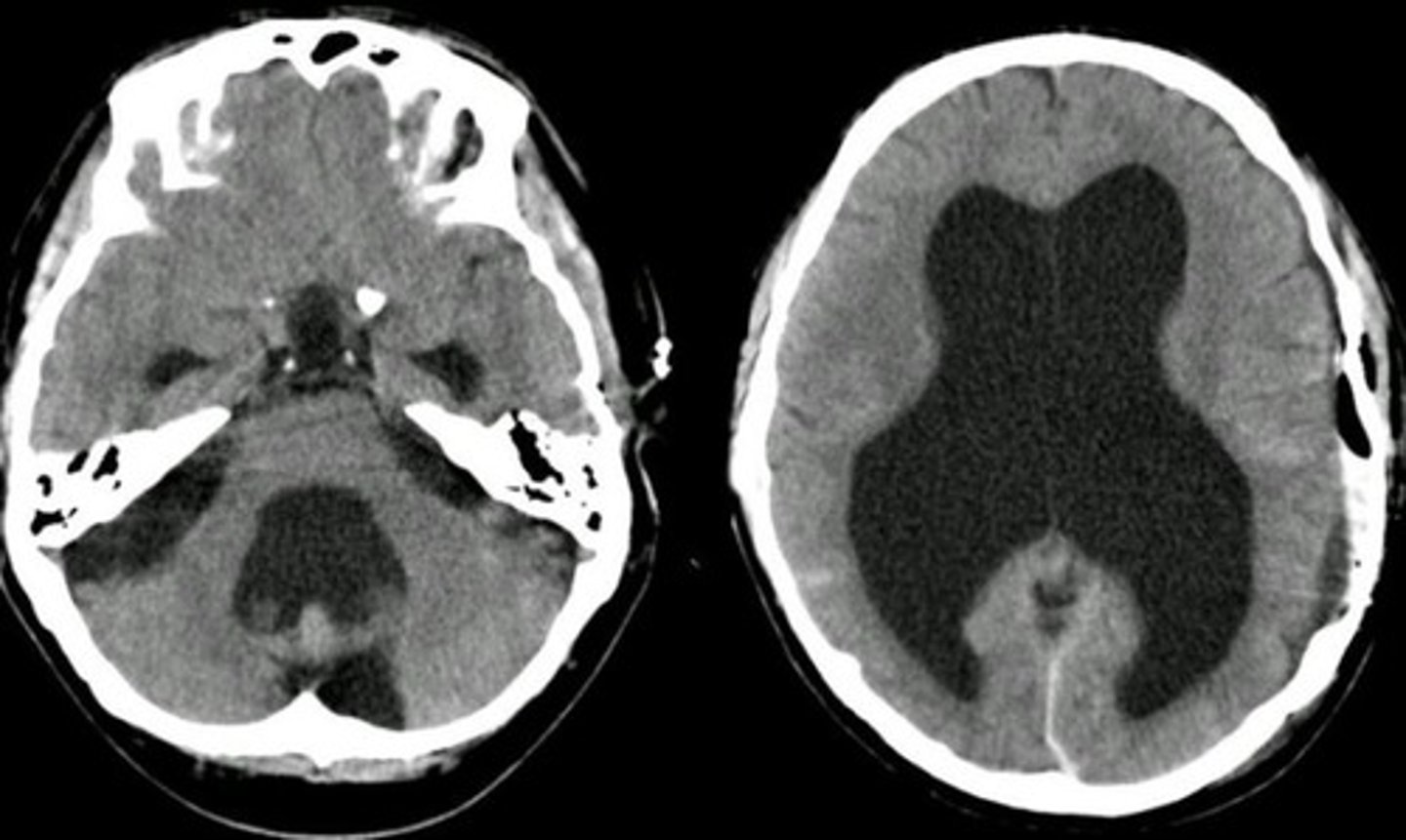 <p>Define Hydrocephalus Type:</p><p>-Obstructed CSF Flow</p><p>at Foramen of Munro or Cerebral Aqueduct</p><p>-Due to mass (tumor, hemorrhage, infection - Ependymitis from "Toxoplasmosis" or "CMV")</p><p>*Would see blocked cerebral aqueduct + temp lobe horns of lat ventricles enlarged*</p>