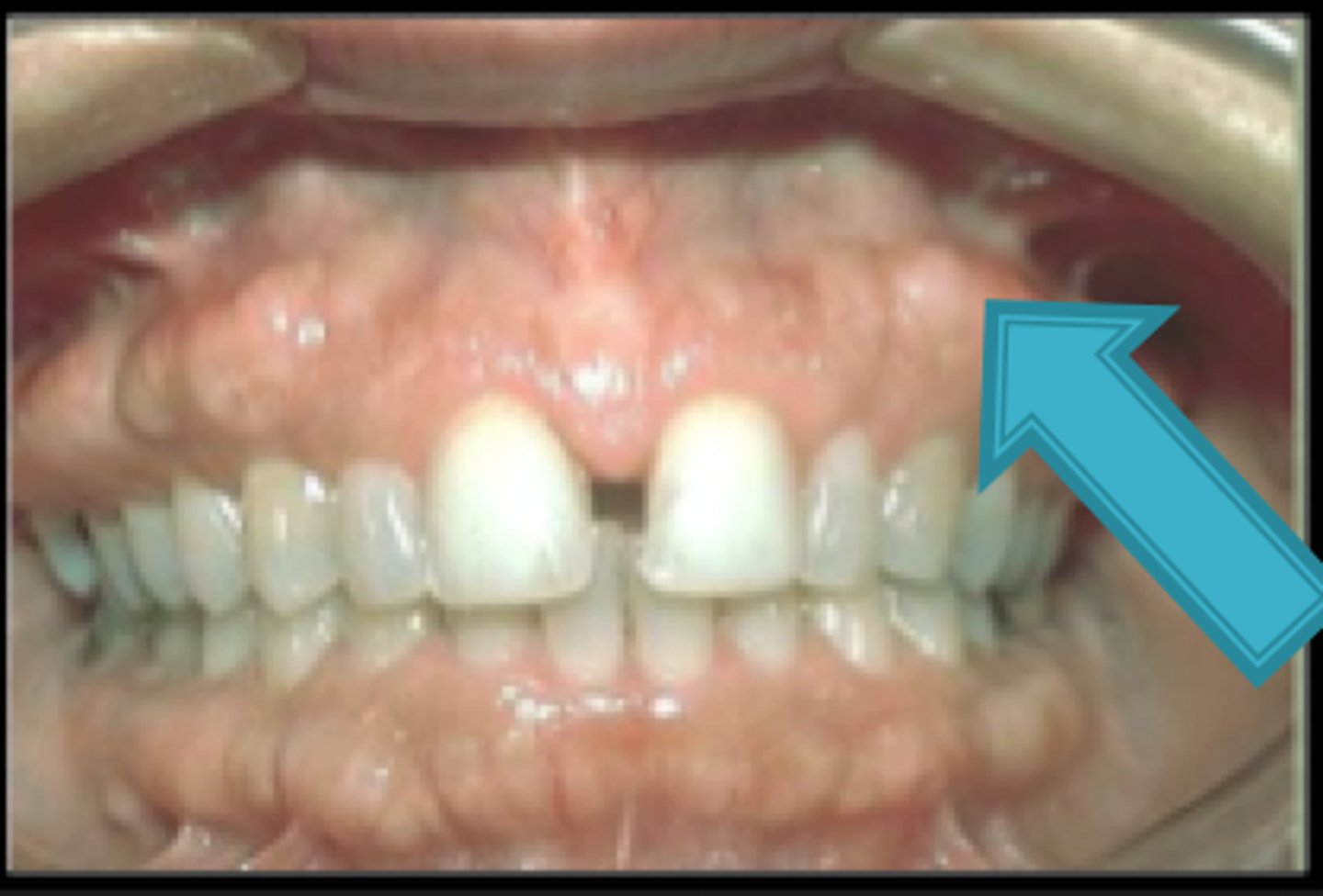 <p>bony growths on the buccal cortical plate of the mandible and maxilla</p>