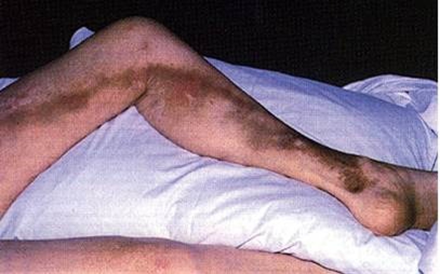 <p>Blood clot in the vein</p>