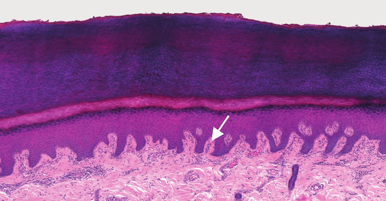 <p>21. In the image, a location marked with an arrow is characteristic of the position of a sensory corpuscle.</p><p>The sensory stimuli perceived by this receptor are primarily transmitted through the:</p><p>A. Lateral funiculus (Funiculus lateralis)</p><p>B. Posterior funiculus (Funiculus posterior)</p><p>C. Anterior corticospinal tract (Tractus corticospinalis anterior)</p><p>D. Spinal tract of the trigeminal nerve (Tractus spinalis nervi trigemini)</p><p>E. Anterior spinothalamic tract (Tractus spinothalamicus anterior)</p>
