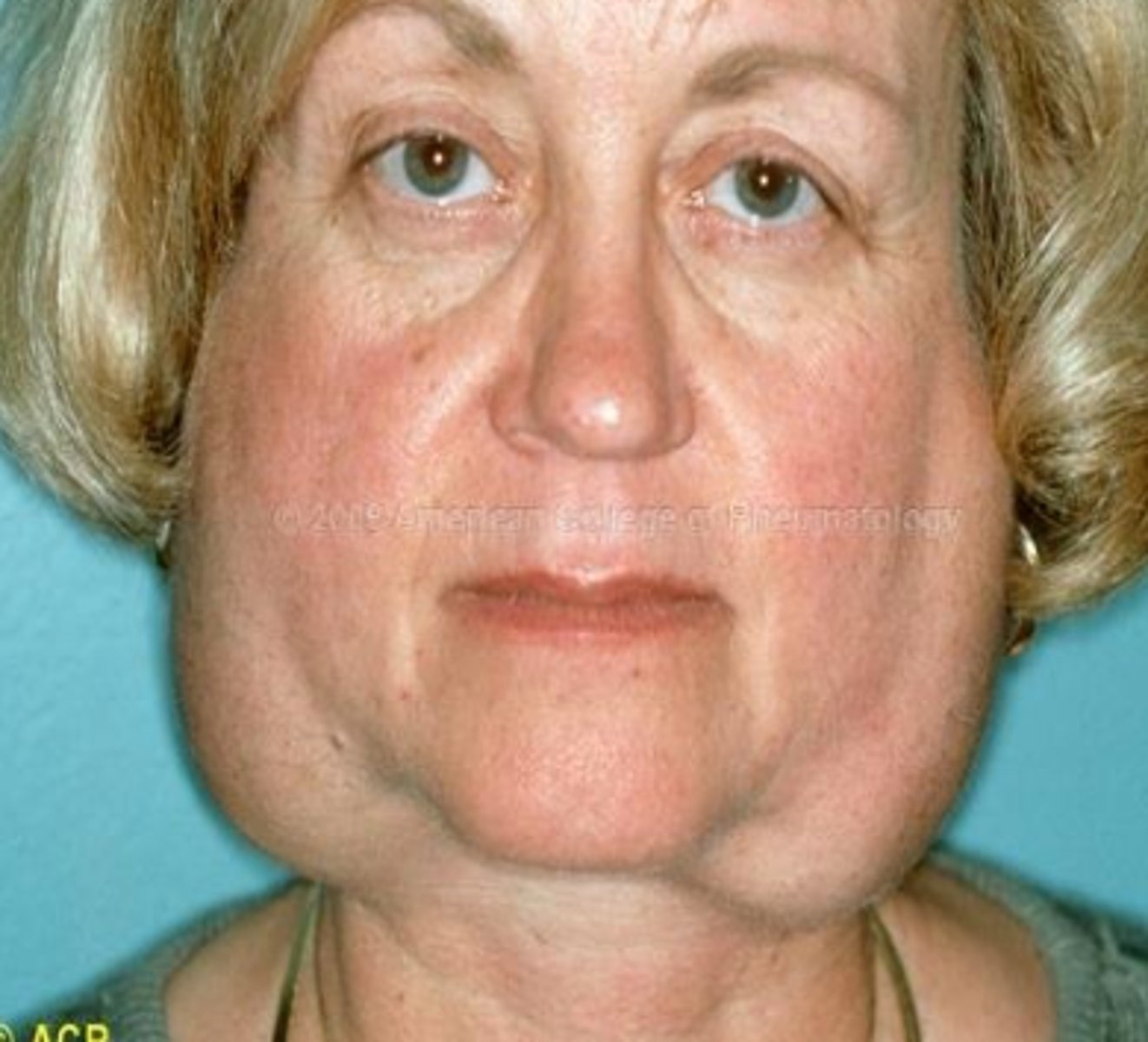 <p>Sjogren syndrome</p>