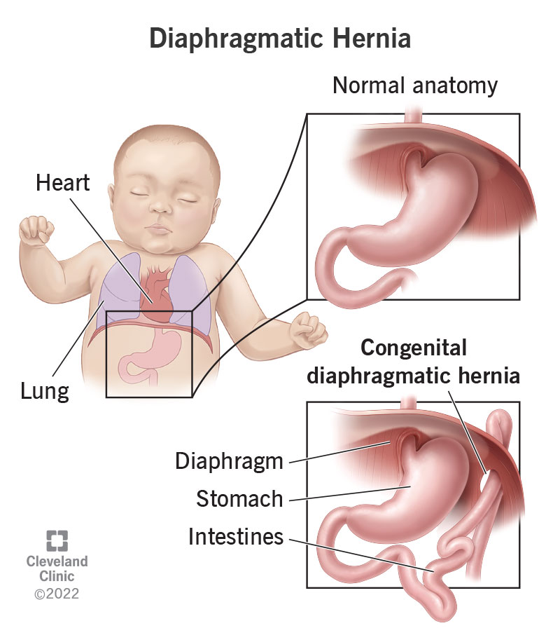 <p>Birth defect where there is a hole in the diaphragm. <span>Organs in the abdomen (such as intestines, stomach, and liver) can move through the hole in the diaphragm and upwards into a baby's chest.</span></p>