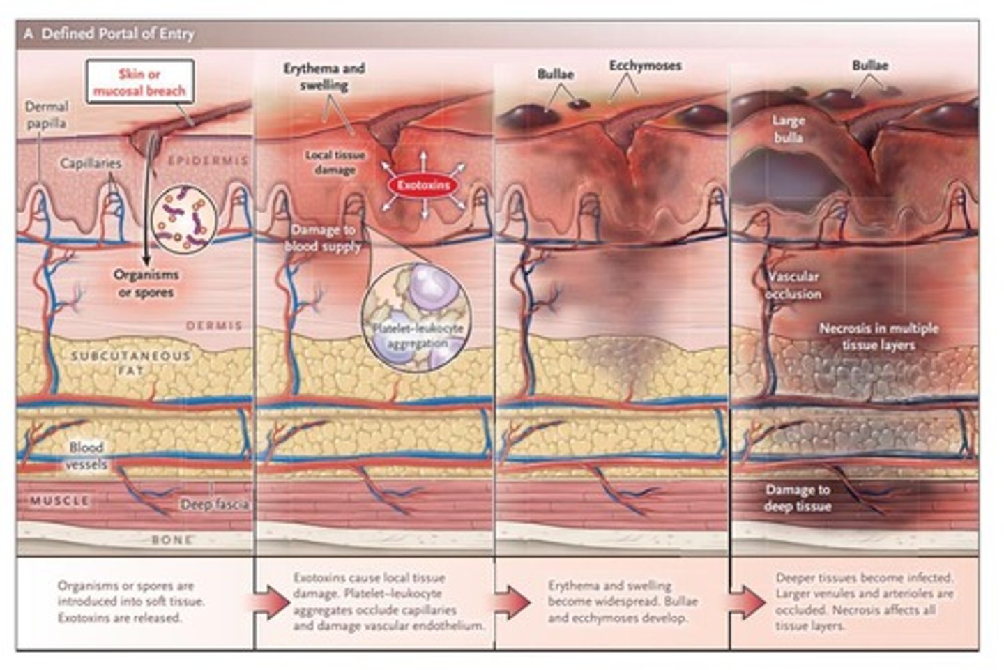 <p>An aggressive infection usually caused by group A Strep or Staphylococcus aureus that leads to tissue death.</p>