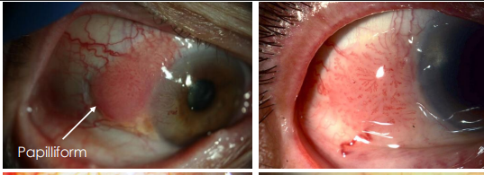 <p><strong><u>• Fleshy, papillomatous appearance</u></strong></p>