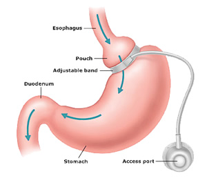 <p>Which type of gastric bypass is shown?</p>