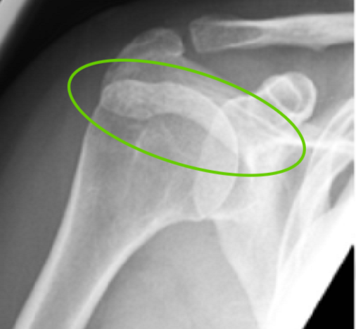 <p>Waist F/E:</p><ul><li><p>SI of ~1/2 acromion and hum</p></li></ul><p></p>