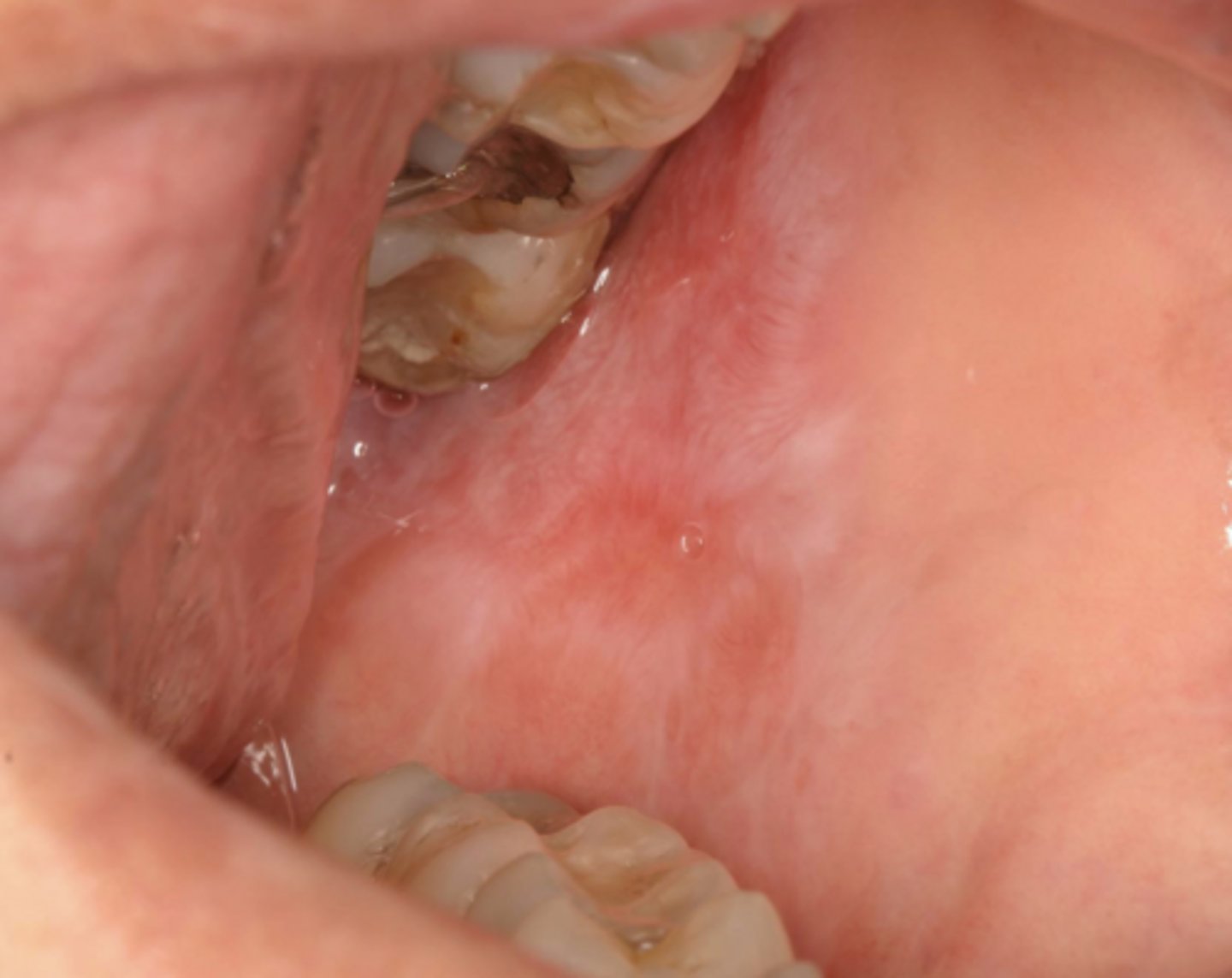 <p>Patient also presents with <strong>kidney disease</strong>. What condition do you suspect?</p>