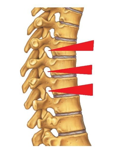 <p>The right and left pedicles have notches on there inferior and superior surfaces that create openings for spinal nerves to leave the spinal cord between adjacent vertebrae</p>