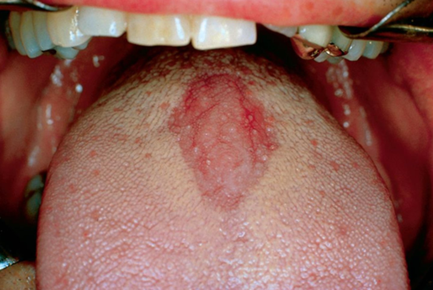 <p>Median Rhomboid Glossitis</p>