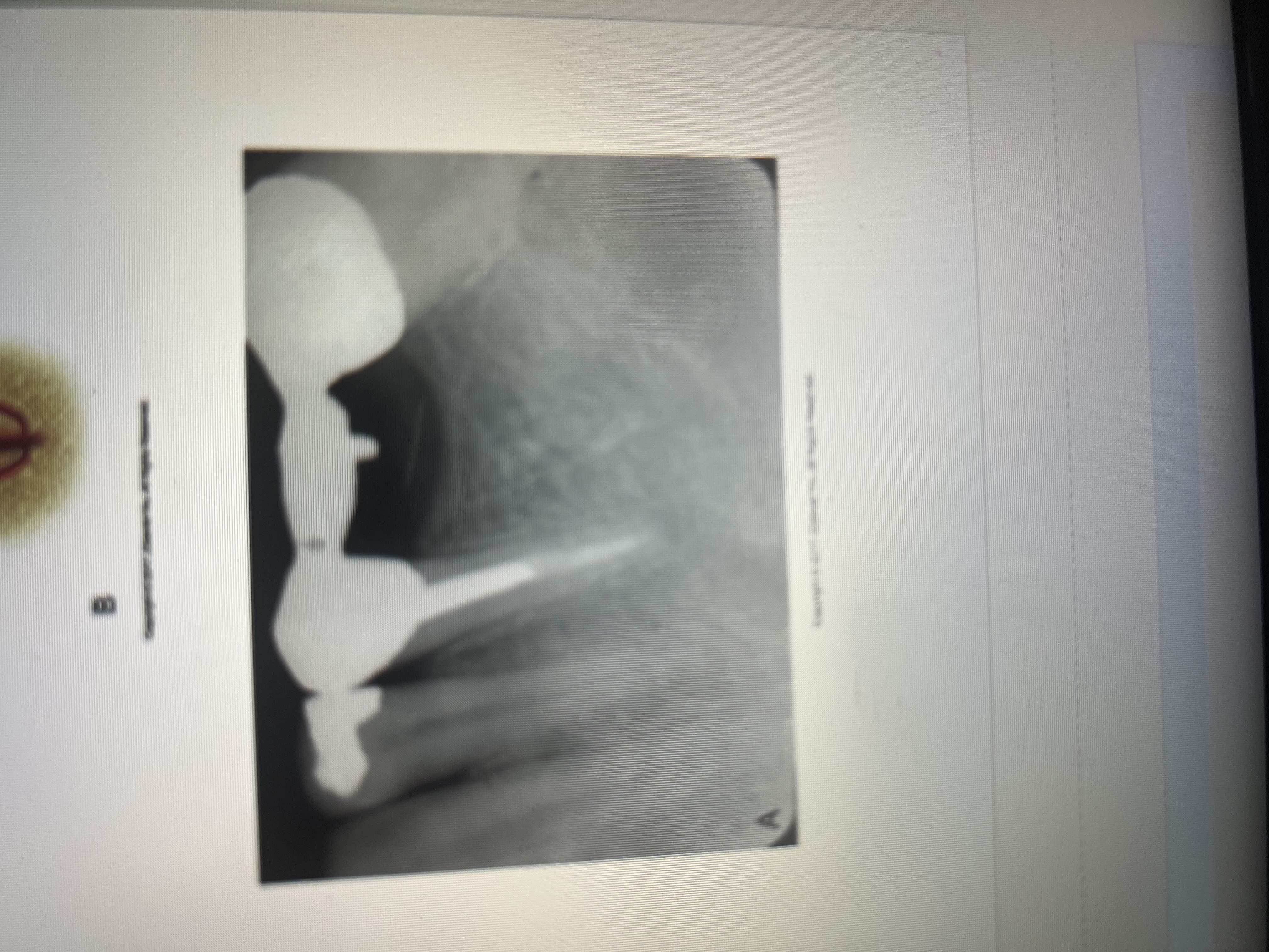 <p>Radiopaque in the crown with the pot potion extending into the canal </p>