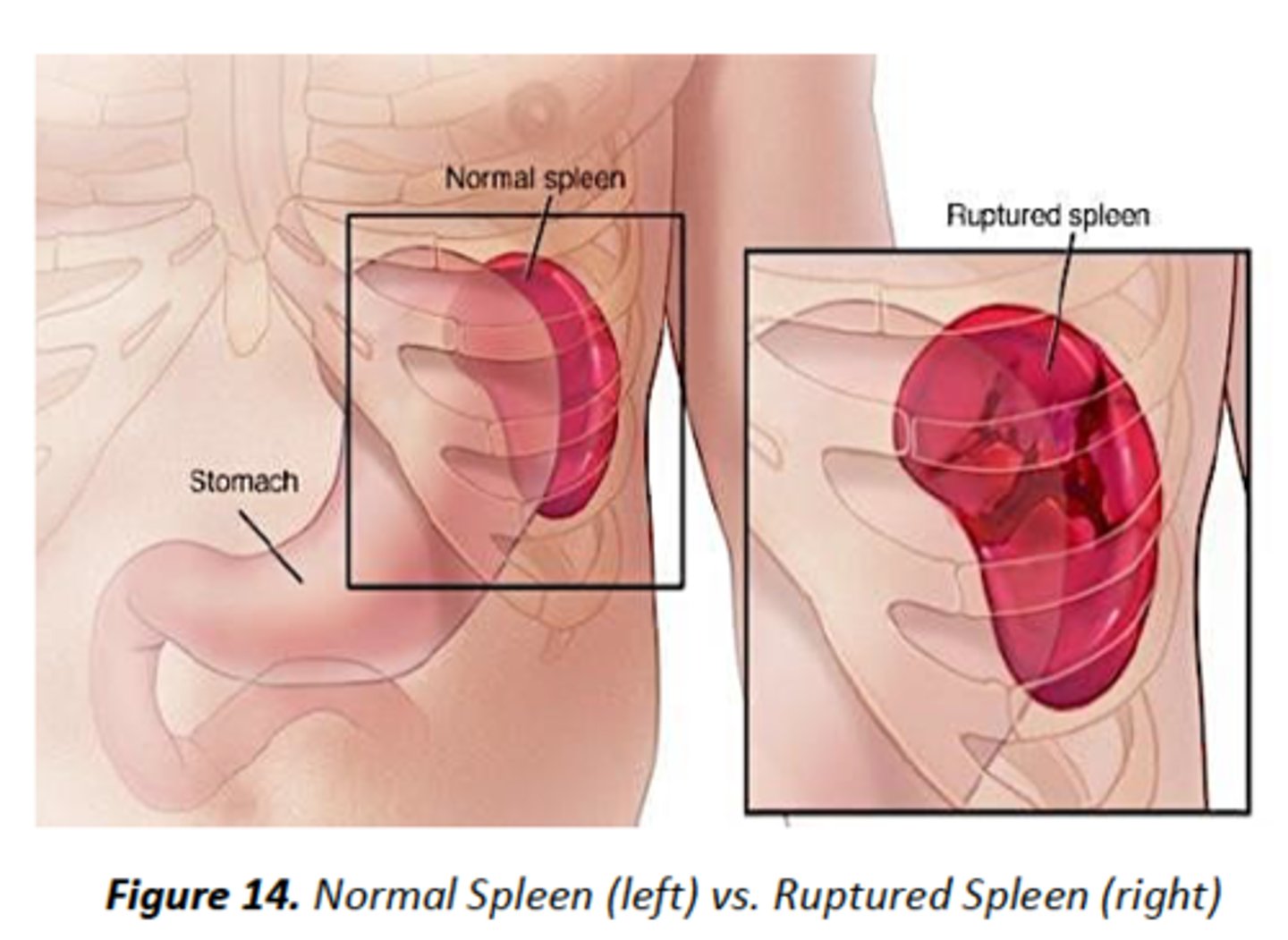 <p>Spleen rupture</p>