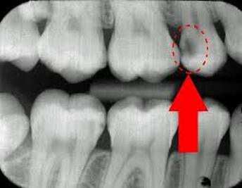 <p>Tooth decay caused by bacteria.</p>
