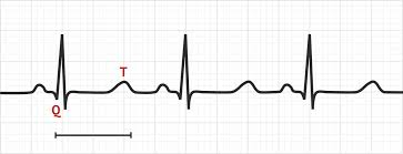 <p>Long QT interval</p>