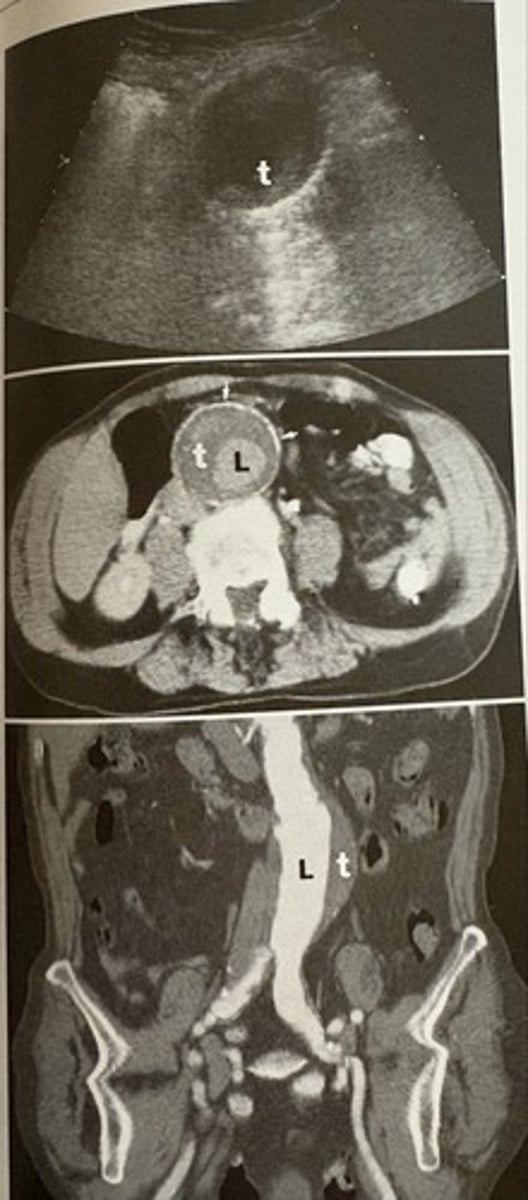 <p>what pathology is present?</p>