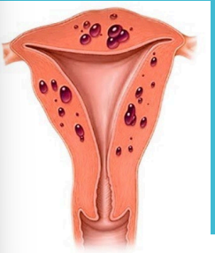 <p><strong>Uterine Adenomyosis: Background</strong></p><p>-Disorder in which endometrial glands and stroma are present within the myometrium, resulting in ___________ of the surrounding myometrium</p><p>-Pathogenesis is unknown</p><p>-Usually occurs in the 4th and 5th decades of life</p><p>-Typical symptoms are heavy menstrual ___________, dysmenorrhea, and chronic pelvic ____</p>