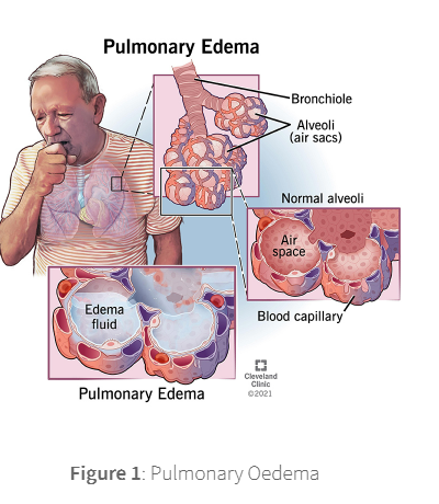 <p><span><span>Pulmonary oedema is defined as an abnormal accumulation of extravascular fluid in the lung parenchyma and disrupt normal gas exchange.</span></span></p>