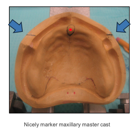 <p>- Circle the incisive papilla</p><p>- Make the front edge of the ruler perpendicular to the mid-palatal suture. Draw lines on the left and right land areas, directly beneath the front edge of your ruler</p>