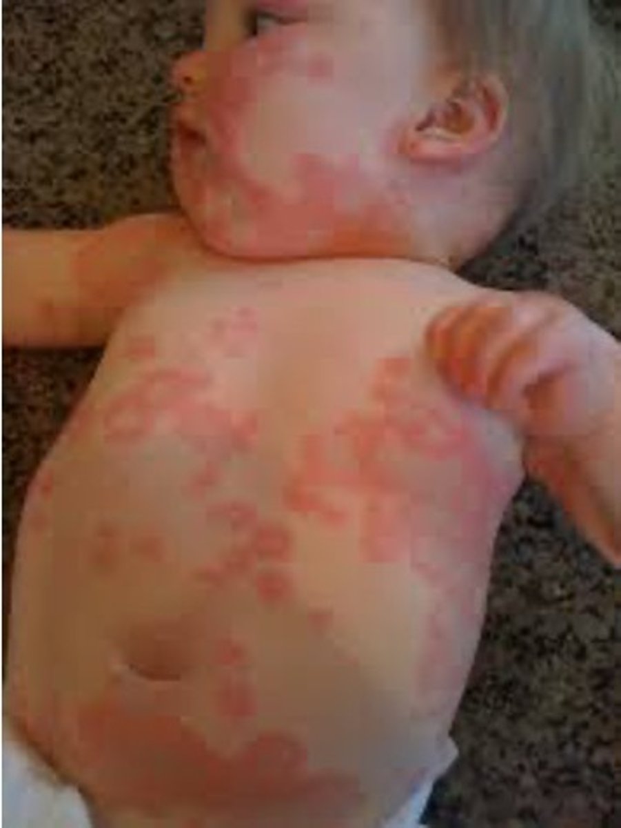 <p>causes ring worm or tinea</p>