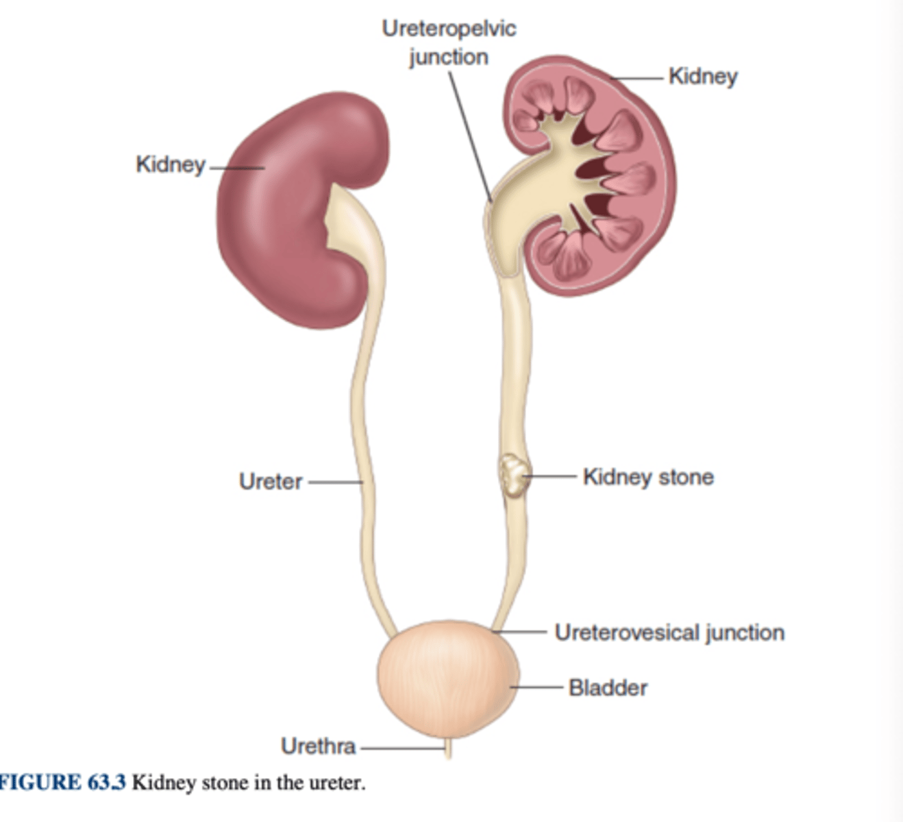<p>condition of stones in the ureters</p>
