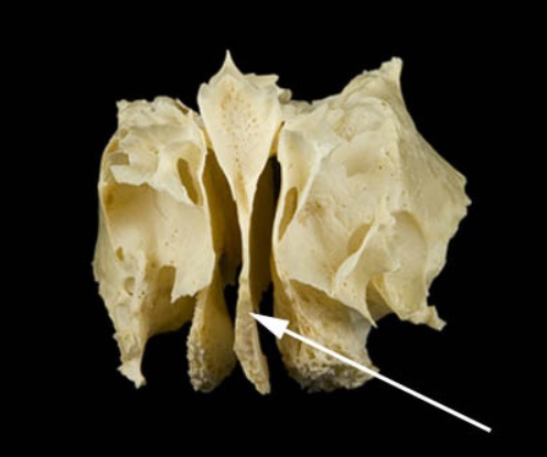 <p>name this structure AND the cranial bone it is a part of</p>