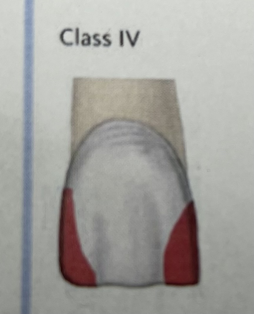 <p>Chipped tooth restoration, anterior teeth</p>