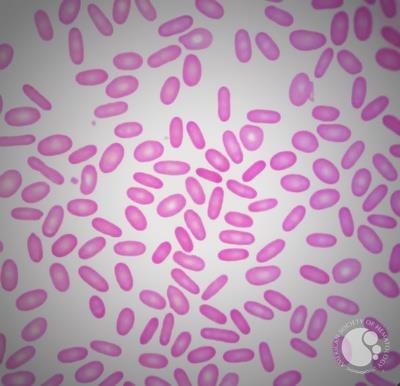 <p>Identify the type of red cells seen in the image.</p>