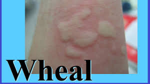 <p><span>A localized swelling of the upper portion of skin. This is usually pink and itchy.</span></p>