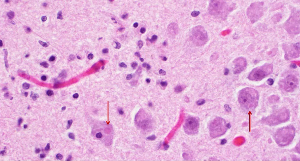 <p>Negri bodies seen in this image are characteristic of what disease?</p>
