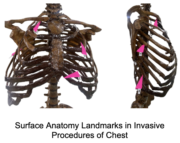 <p>Which of these is the Area-of-Choice/Point-of-Entry for: <span>Chest-Tube Thoracostomy for Adult Patients</span></p>
