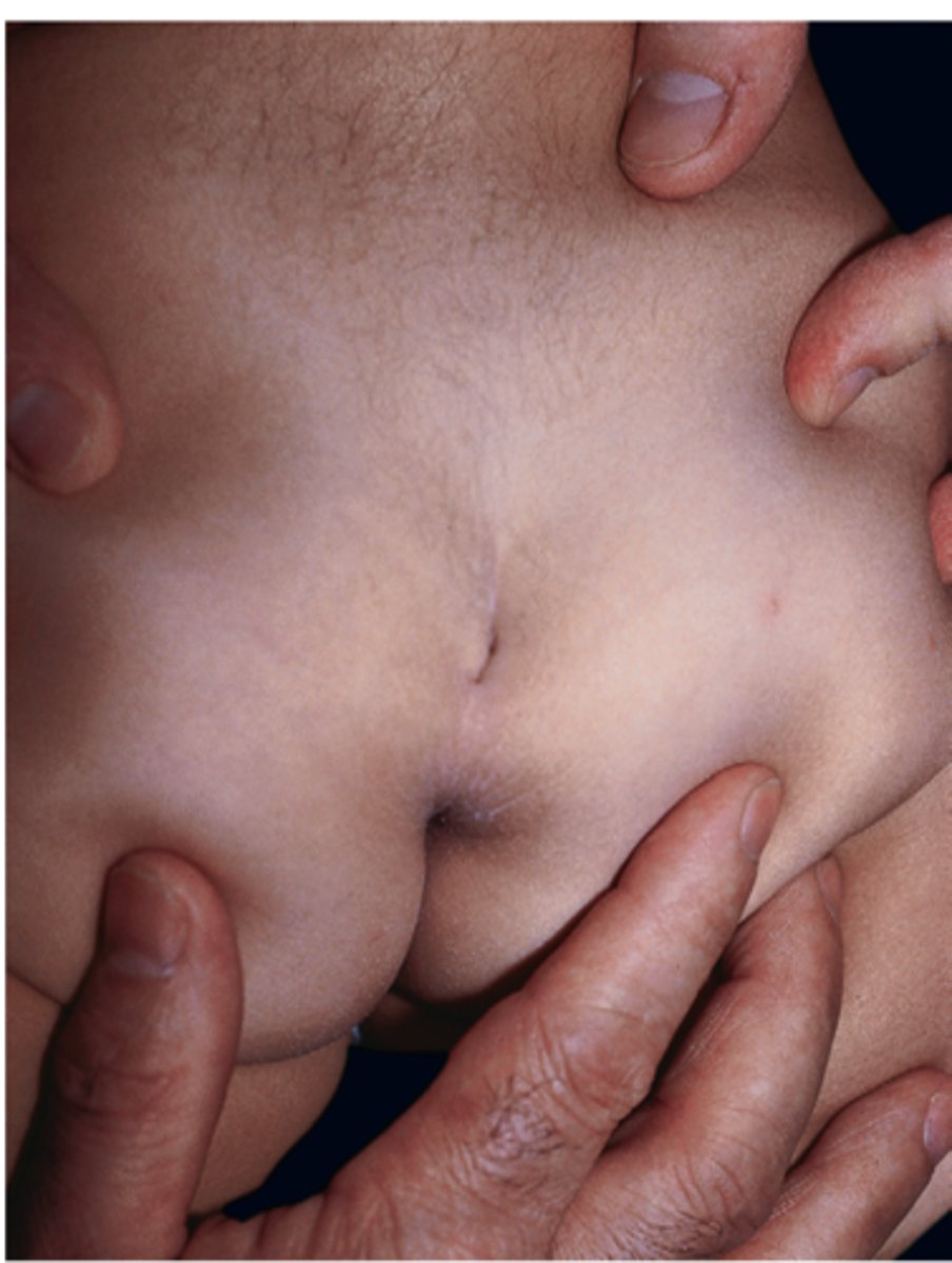 <p>opening in the skin over the distal spine</p><p>might have neuro issues</p>