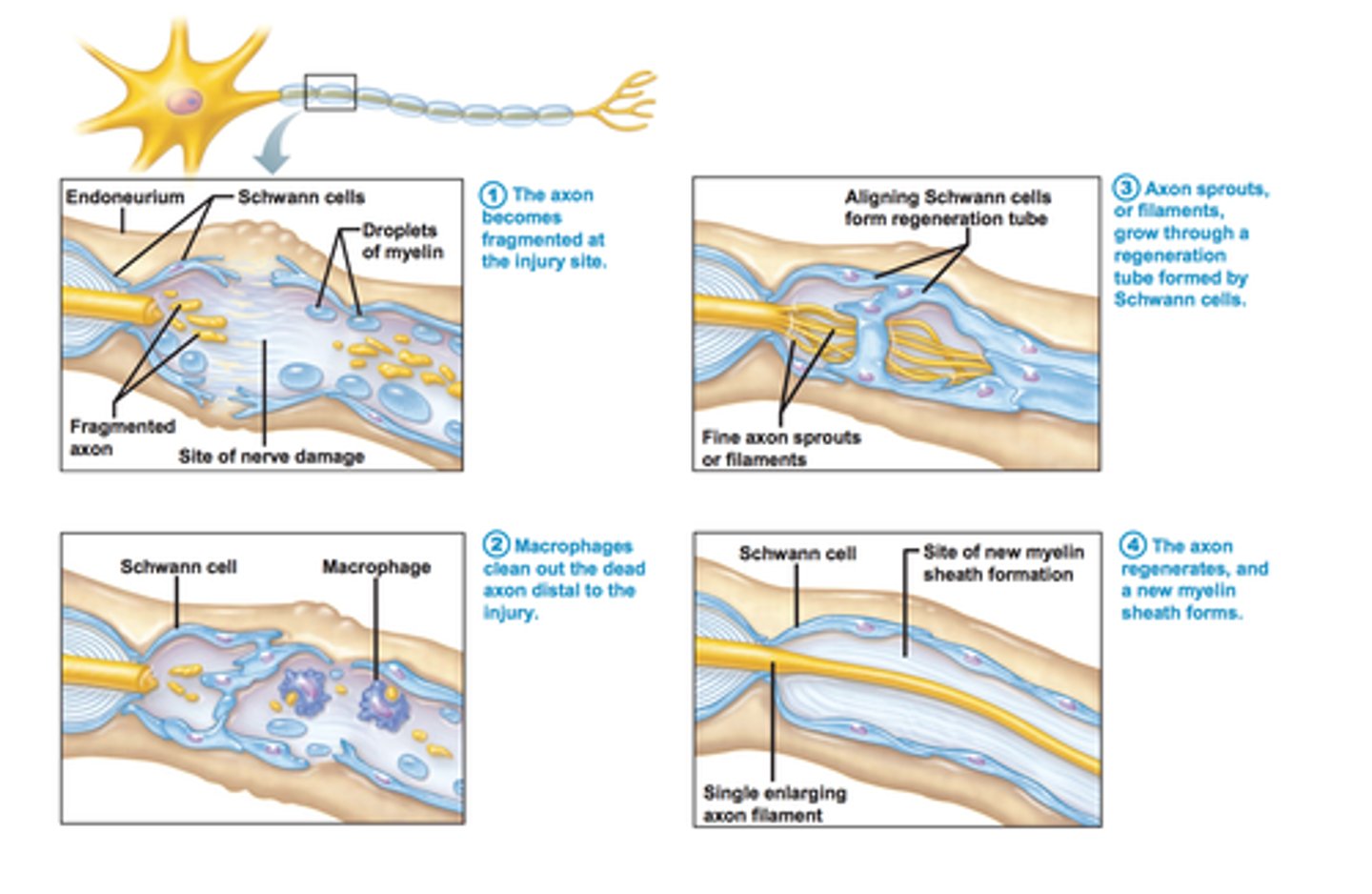 <p>1. axon fragments which causes axon &amp; myelin sheath distal to injury to degenerate<br>2. schwann cells recruit macrophages to clean up debris &amp; stimulate schwann cells to divide<br>3. schwann cells line up &amp; form a regeneration tube that encourages &amp; guides axon filament growth<br>4. schwann cells protect axon as it regenerates &amp; forms new myelin sheath</p>