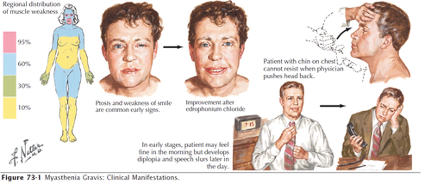 <p>an autoimmune disease, antibodies damage or destroy the acetylcholine receptors at the motor end plate of a neuromuscular junction- serious muscle weaknesss, worsens with activity</p>
