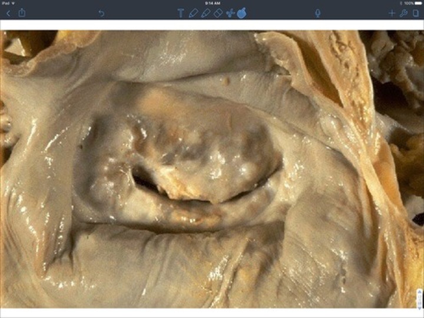 <p>rheumatic valve disease</p>