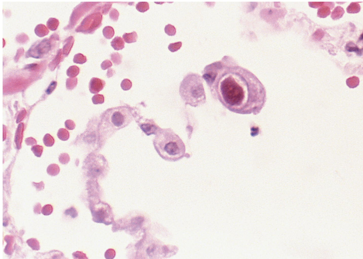 <ul><li><p>PCR</p></li><li><p> Detection of viral nucleic acid in whole blood or plasma by EIA</p></li><li><p> Isolation of virus from human body tissue is confirmatory</p></li><li><p> In lung fibroblast cells, it produces<strong> large, basophilic, intranuclear inclusions called an “owl eye”</strong></p></li><li><p> Serology tests can have cross reactions and cannot tell if active infection</p></li></ul><p></p>