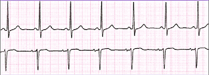 <p>Rate: 60-100 BPM<br>Rhythm: Regular<br>P-Wave: Present and Consistent<br>PR: 0.12-0.20<br>QRS: 0.06-0.10</p>