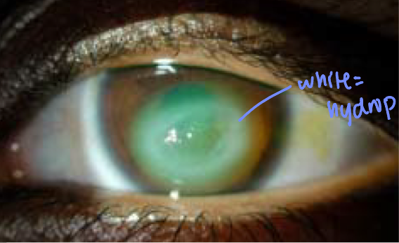 <ul><li><p>breaks in Descemet membrane causing aqueous into the stroma resulting in <em>stromal edema</em></p></li><li><p>complication of keratoconus</p><ul><li><p><span>Occurs in approximately 3% of keratoconic patients</span></p></li><li><p><span>Seen in advanced keratoconus</span></p></li></ul></li><li><p><span><strong>Symptoms</strong>: pain, photophobia, epiphora and decreased vision</span></p></li><li><p><span><strong>Presentation</strong>: corneal haze</span></p><ul><li><p><span>Conjunctival hyperemia, anterior chamber reaction</span></p></li></ul></li><li><p><strong>Treatment</strong> (heal in 6-10wks):</p><ul><li><p><span>Topical cycloplegics (helps with pain control)</span></p></li><li><p><span>Hypertonic salt ointment</span></p></li><li><p><span>Topical antibiotic solutions (helps prevent secondary infection)</span></p></li><li><p><span>Topical NSAID</span></p></li><li><p><span>Topical corticosteroid</span></p></li><li><p><span>Bandage contact lens</span></p></li></ul></li></ul><p></p>