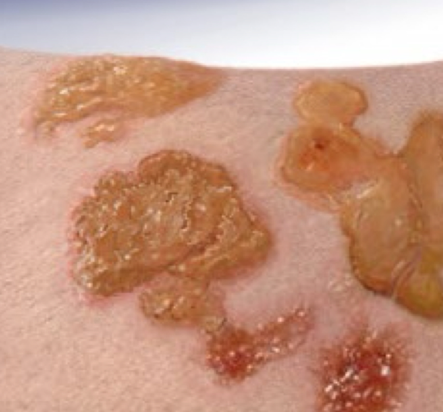 <p>what type of lesion is depicted</p>