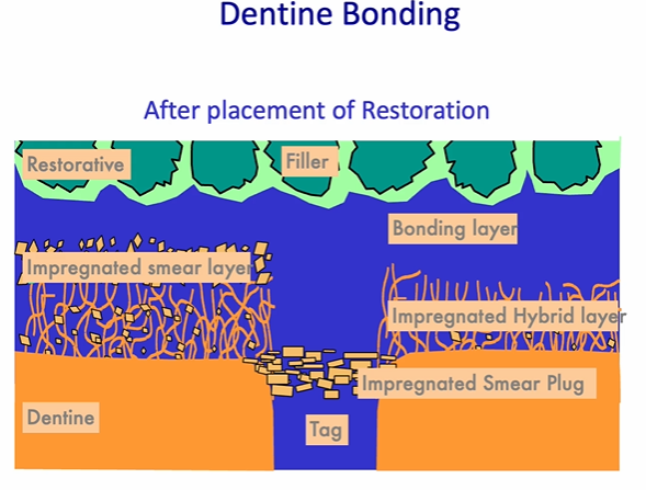<p>after placement of the restoration&nbsp;</p>