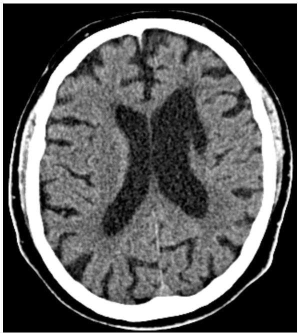 <p>What does this CT image show?</p>