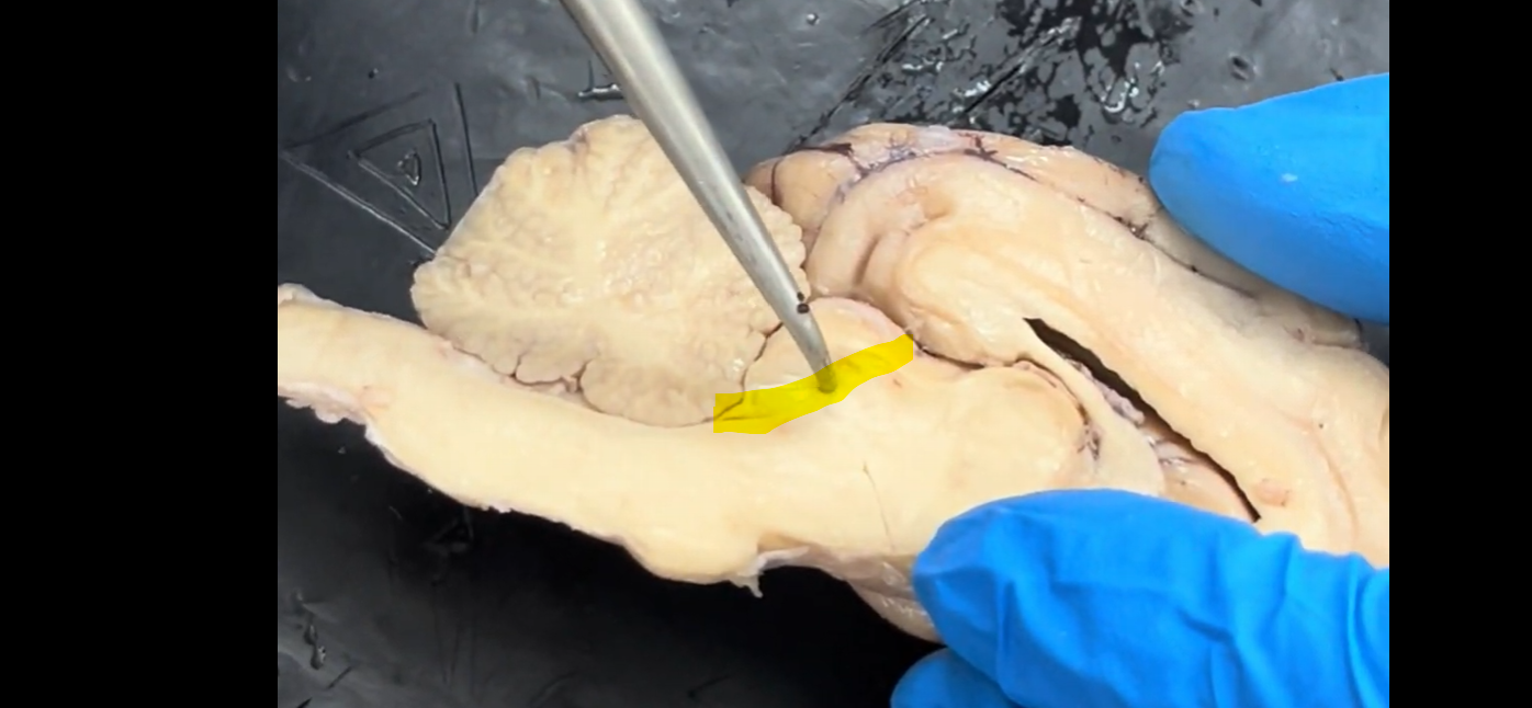 <p>Name the highlighted groove that runs between the third and fourth ventricles.</p>