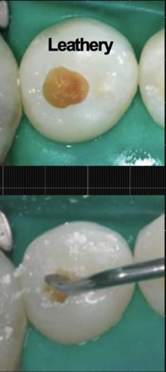 <p>Although dentin does not deform when an instrument is pressed onto it LEATHERY dentin can still be easily lifted without much force being required</p><p>May be little difference between leathery and firm dentin, with leathery being a transition on the spectrum between soft and firm dentin</p>