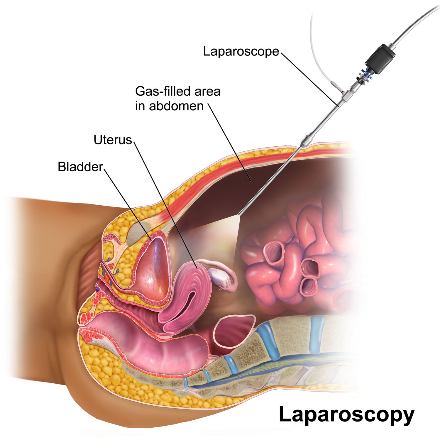 <p>Laparoscopy</p>