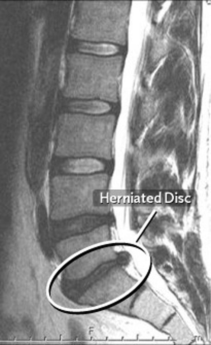 <p>Nucleus pulposus leaks due to tear.</p>